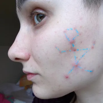 How to feel confident with acne