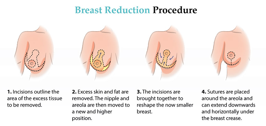 Breast reduction surgery