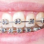 What It's Really Like To Have Braces: Are They Worth It?